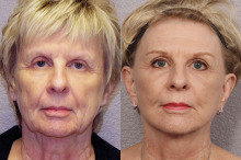 Dr Laris of Phoenix Skin will be speaking at the January Women’s Exchange meeting about beauty breakthroughs, specifically mini facelifts, as part of our New year, New You theme. This picture is of an actual patient that has had the procedure.