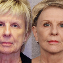 Dr Laris of Phoenix Skin will be speaking at the January Women’s Exchange meeting about beauty breakthroughs, specifically mini facelifts, as part of our New year, New You theme. This picture is of an actual patient that has had the procedure.